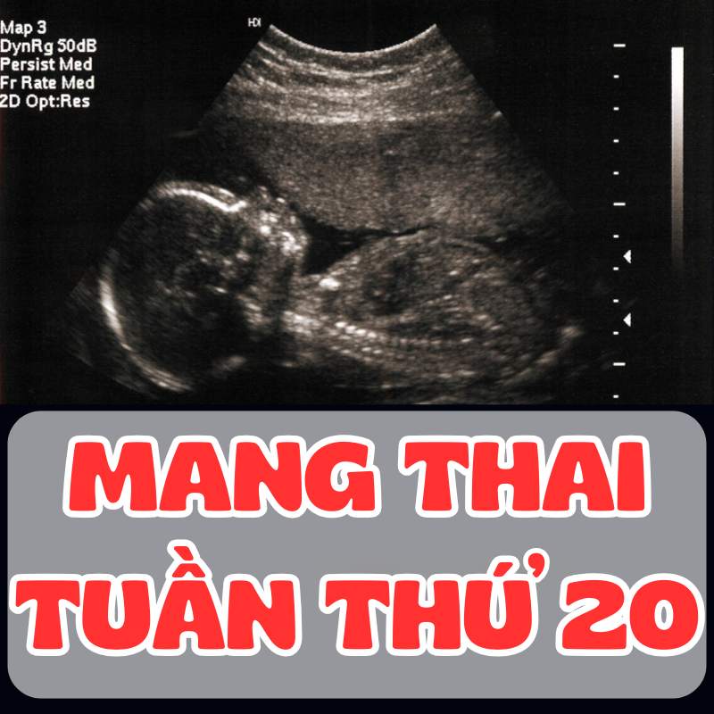 Siêu âm thai nhi tuần thứ 20